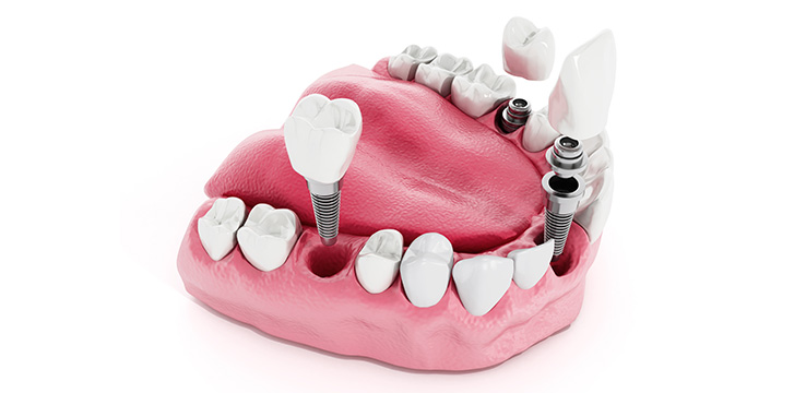 a model of the bottom jaw with dental implants being screwed in to it