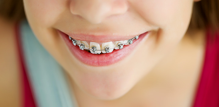 young girl smiling with braces on