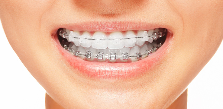 a woman revealing her teeth showing invisilaign braces on the top