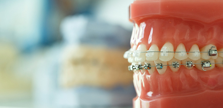 model of teeth and gums used to show how braces fit