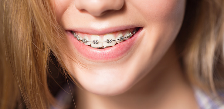 A young teenage girl smiling showing her teeth with braces