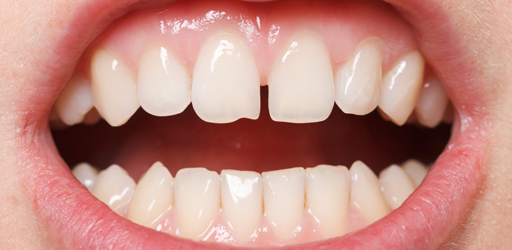 Diastema Dentist Neutral Bay Shore Dental