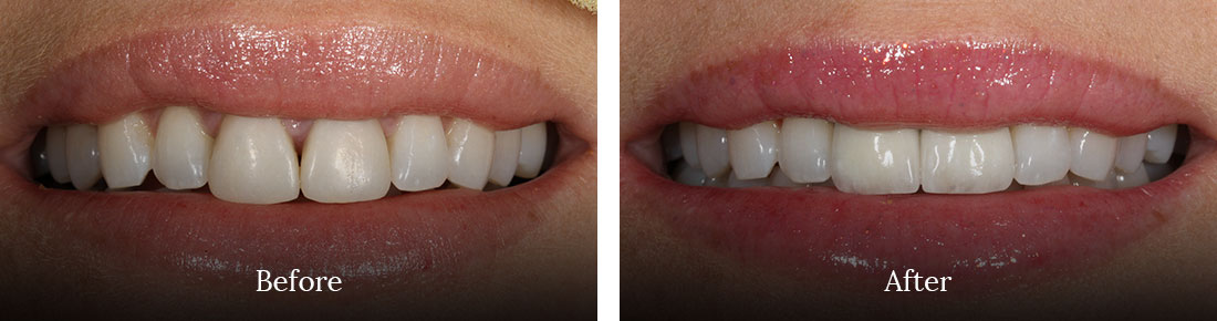 before and after treatment