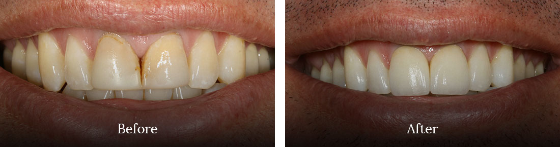 before and after treatment