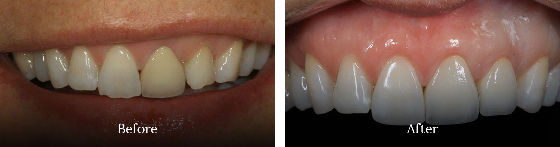 before and after treatment