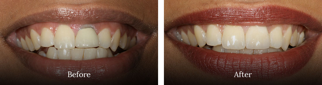 before and after treatment