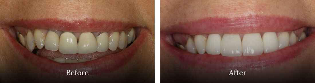 before and after treatment
