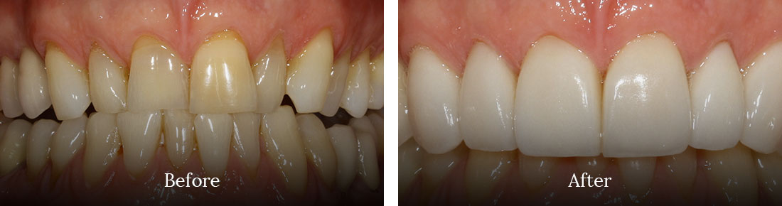 before and after treatment