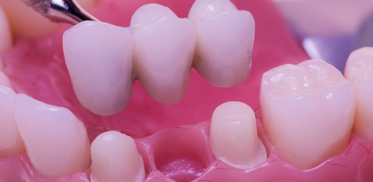a model of dental bridge being implanted