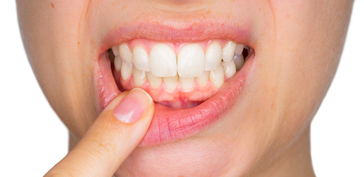 woman holding her lower lip down exposing her gums