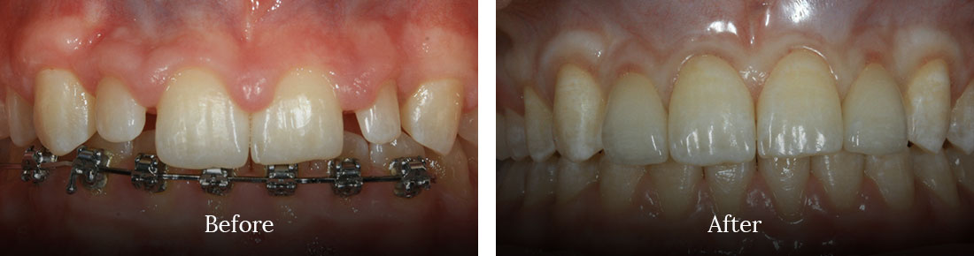 before and after treatment