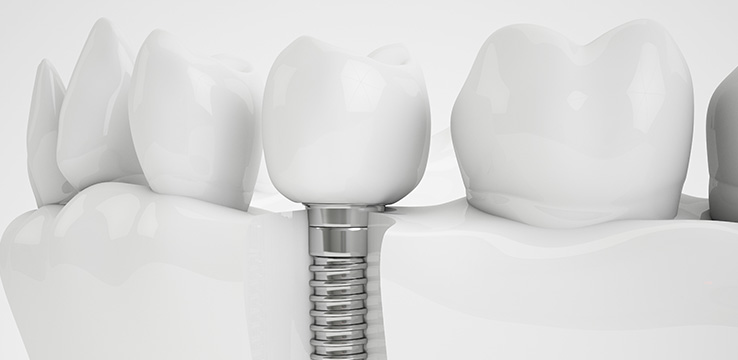 a model of teeth that shows how a dental implant looks under the gums the replacement tooth is screwed in