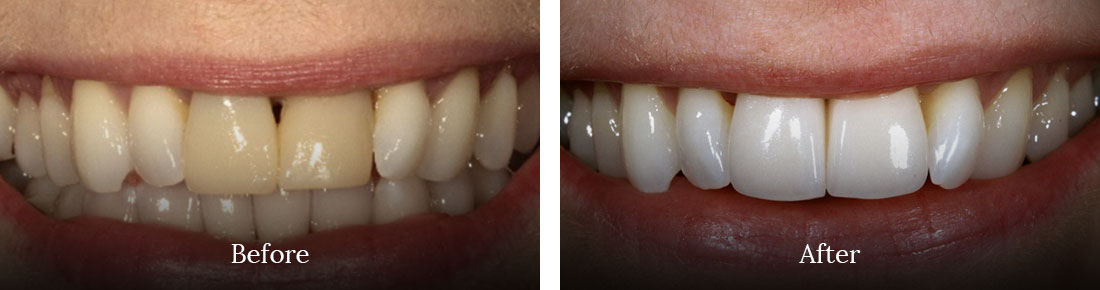 Before and after treatment