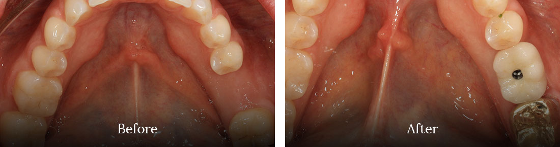 Before and after treatment