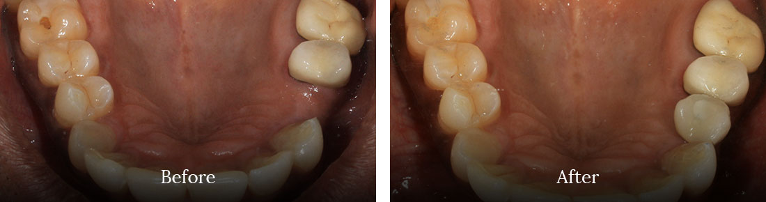 Before and after treatment