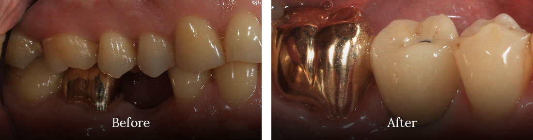 Before and after treatment
