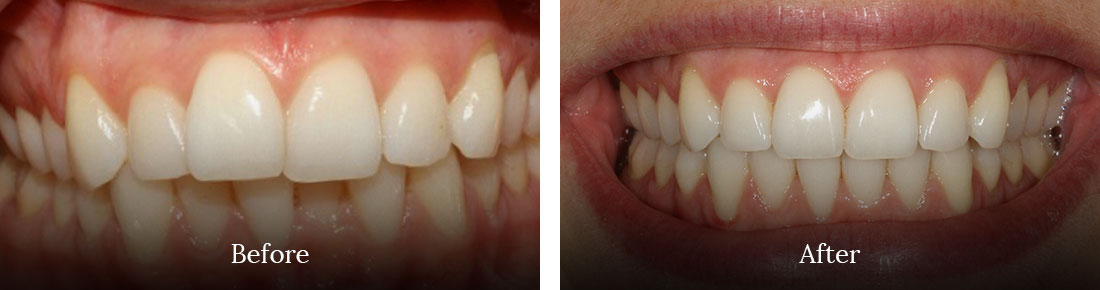 before and after treatment