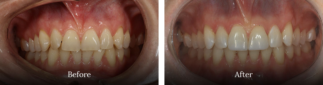 before and after treatment
