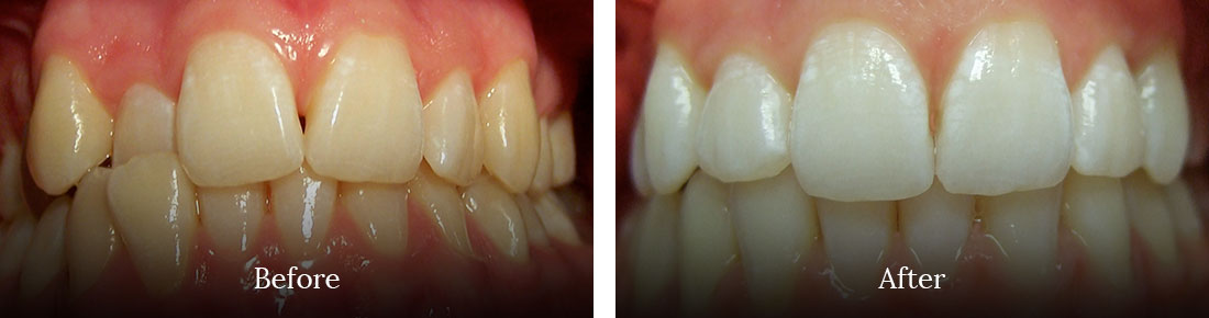 before and after treatment