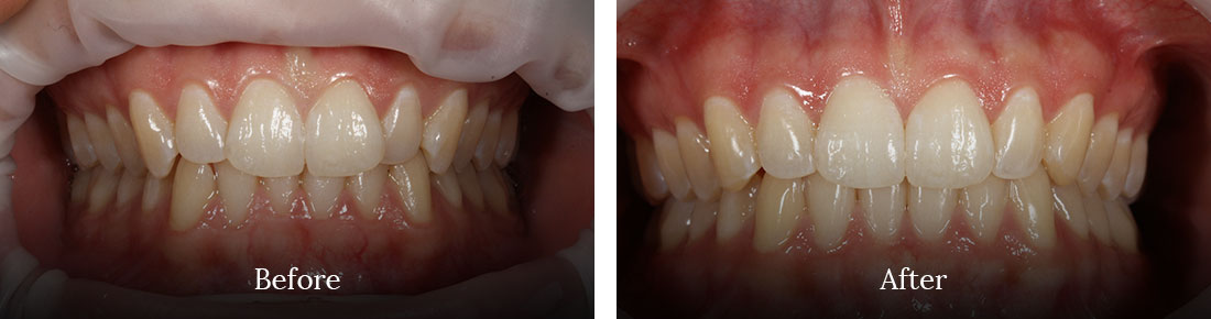 before and after treatment