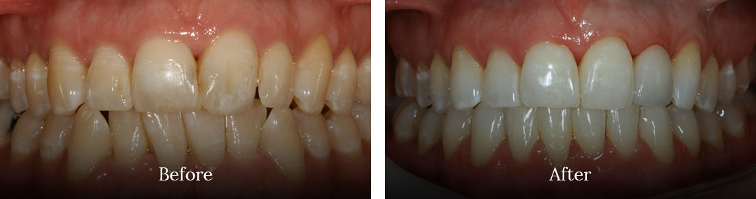 before and after treatment