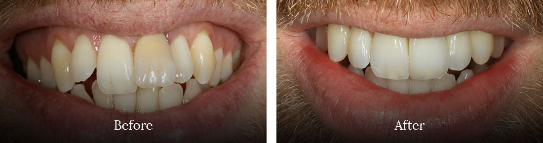 before and after treatment