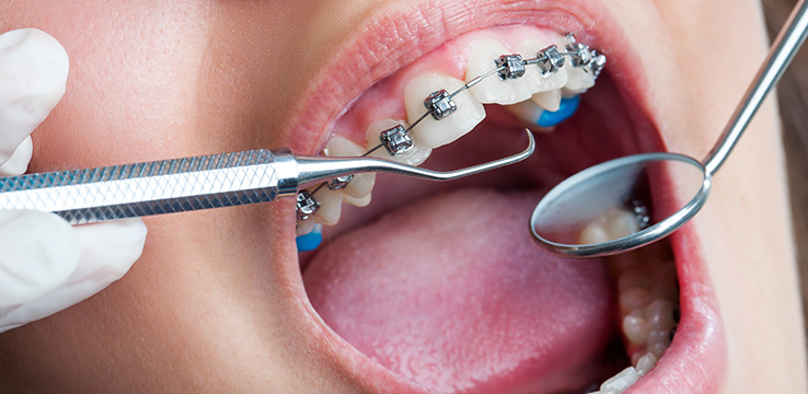 up close view of a mouth with braces and dental tools being used to examine the teeth.