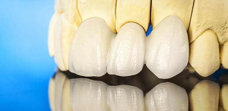 model of a set of teeth with porcelain veneers over the front teeth