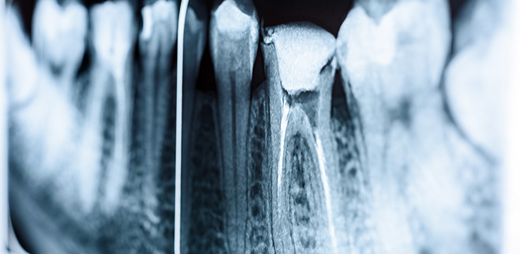 x-ray image of teeth and roots