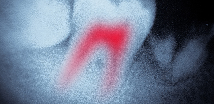 3d image of a tooth with inflamed roots the roots appear in red