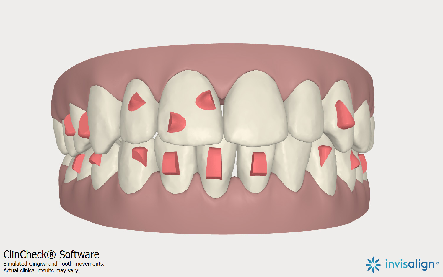 invisalign uses pressure points to move teeth