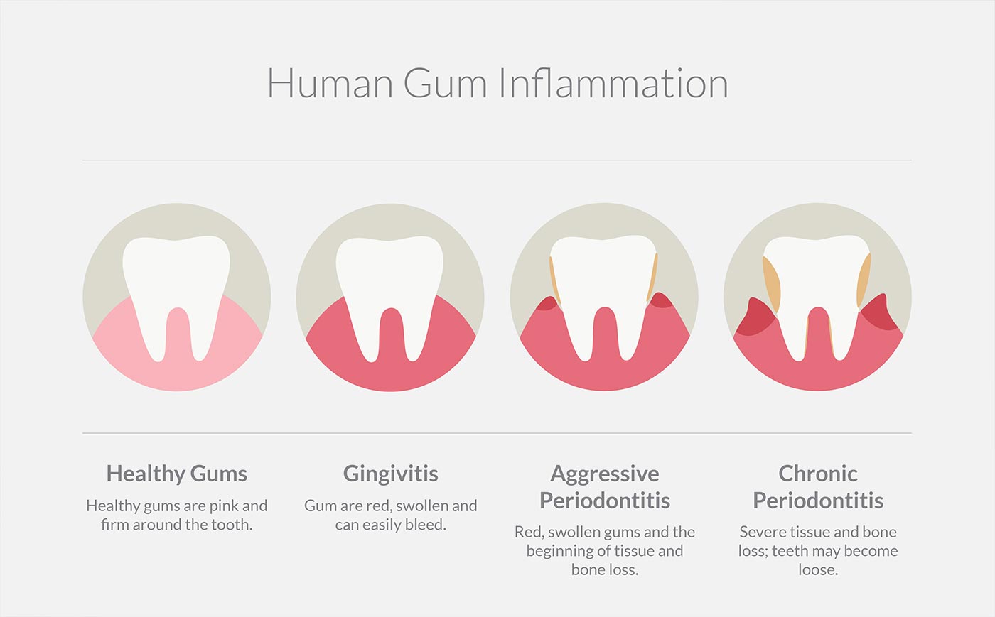 four stages of healthy gums to periodontitis