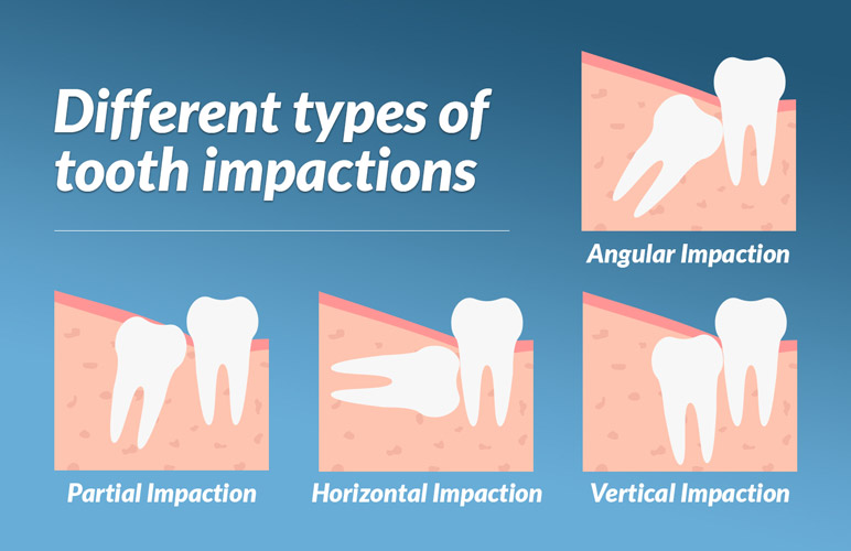 images of kinds of wisdom tooth impactions