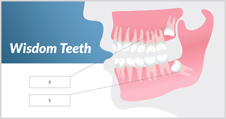 graphic of top and bottom wisdom teeth