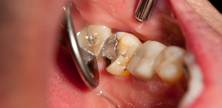 mouth open showing a tooth with silver fillings