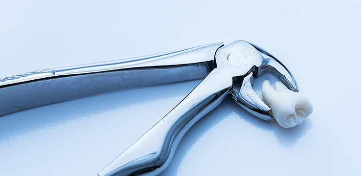 tooth being held by surgical pliers