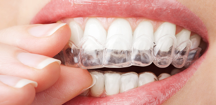 a woman putting a guard on her upper teeth