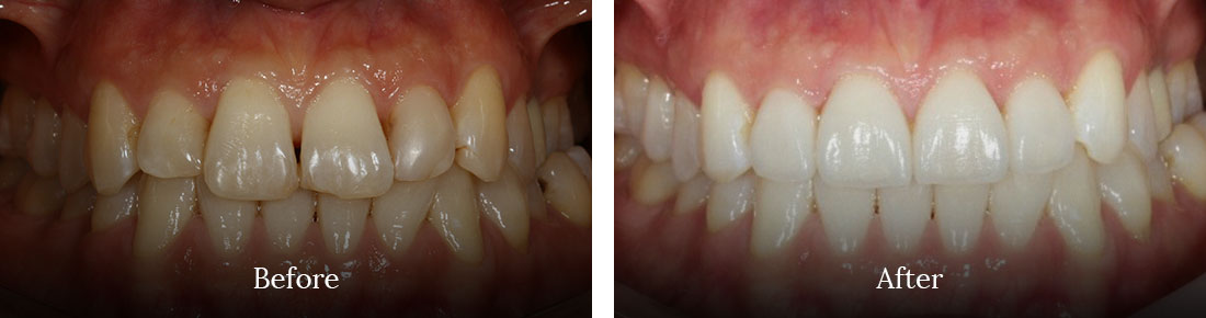 before and after treatment