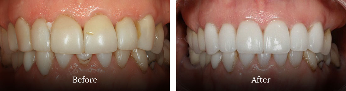 before and after treatment