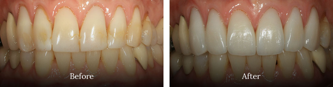 before and after treatment