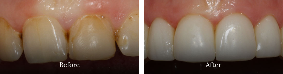 before and after treatment