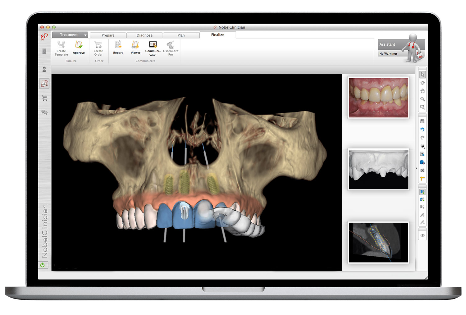 3d image of how your implants will look