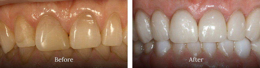 before and after treatment