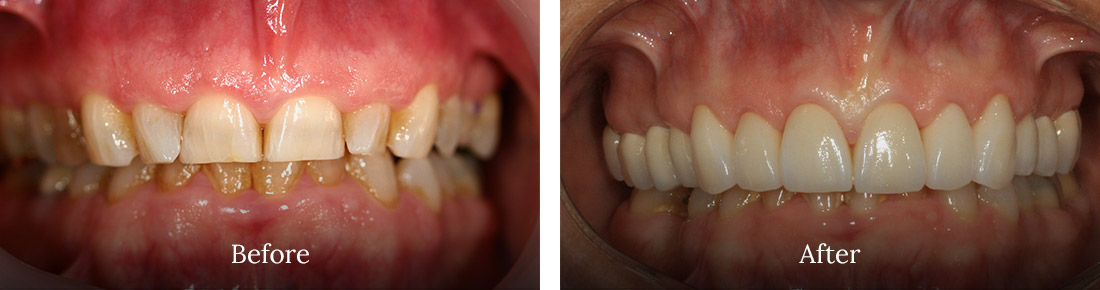 before and after treatment