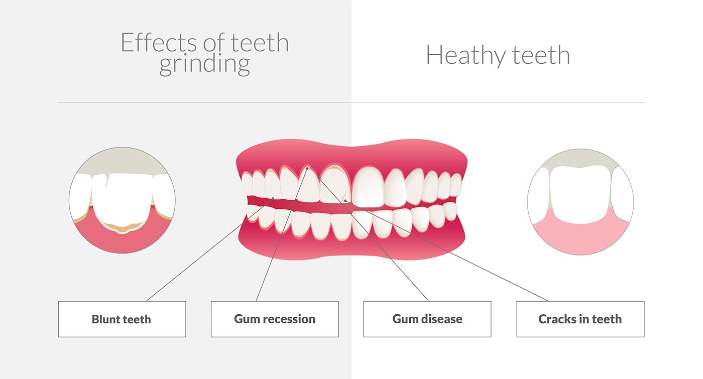 what happens if you grind your teeth infographic