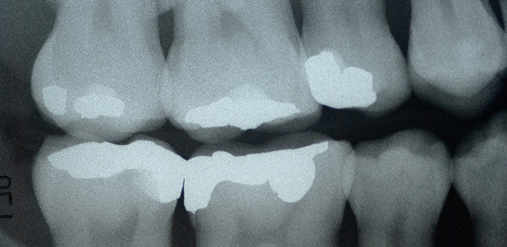 x-ray of a persons teeth with dental fillings