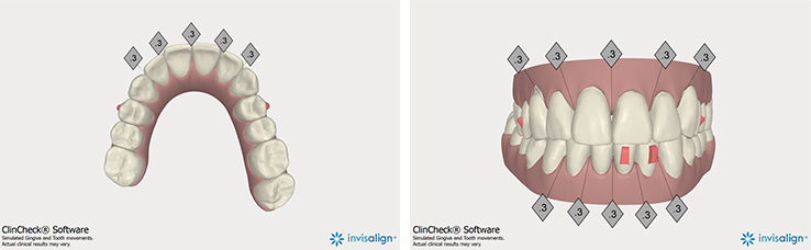 shore dental patient case study insivalign treatment