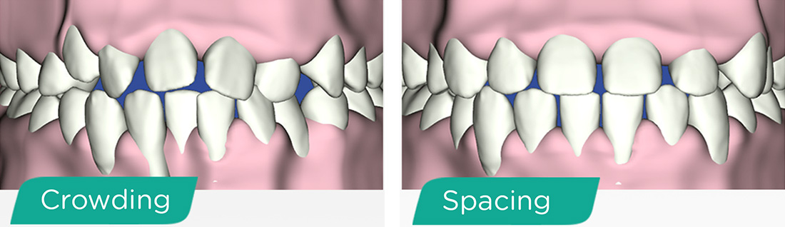 crowding and spacing fix graphic