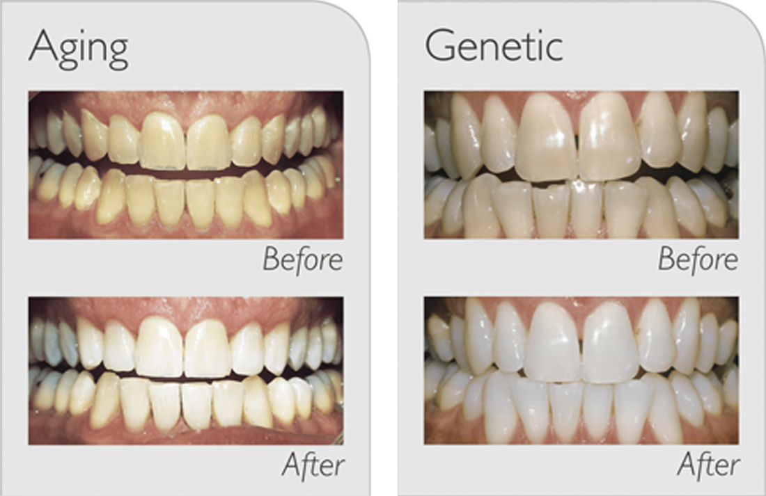 before and after shots of teeth that have been whitened