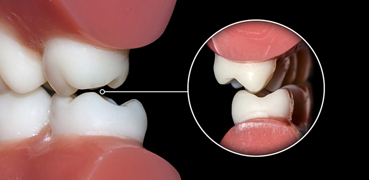 model teeth being used to show what teeth grinding is